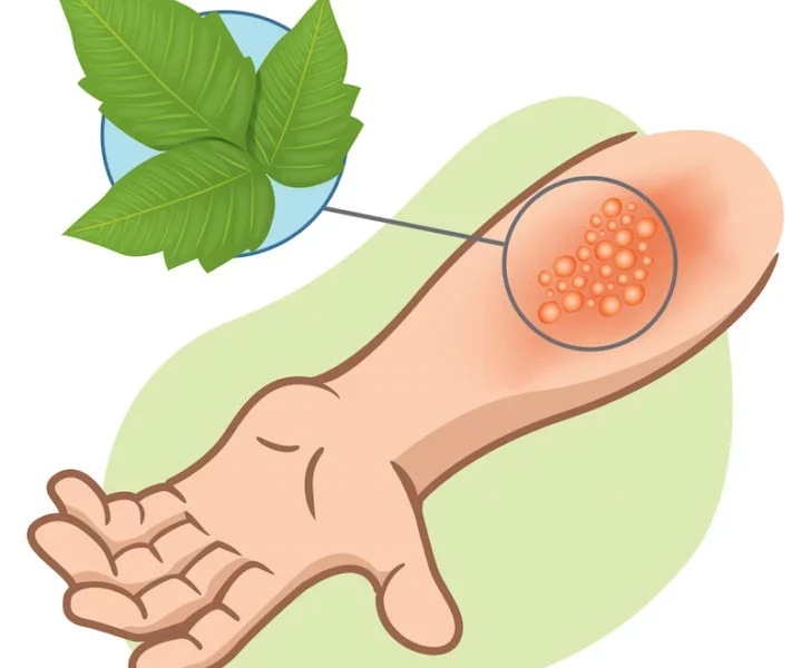  what-to-do-about-poison-ivy,-oak,-&-sumac:-first-aid,-prevention,-and-relief